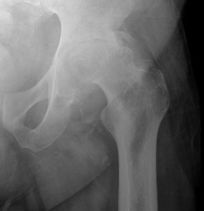 Figure 1B: Arthritic hip Note complete obliteration of joint space with deformity.