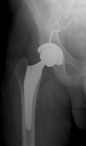 Figure 2: Total hip replacement