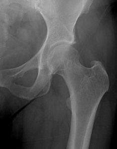 Fig. 1A: Normal hip x-ray Note preservation of joint space and congruent hip.